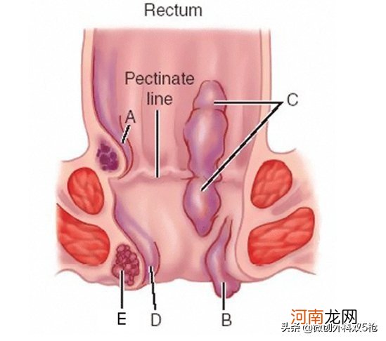 如何判断自己是不是得了痔疮 如何预防痔疮