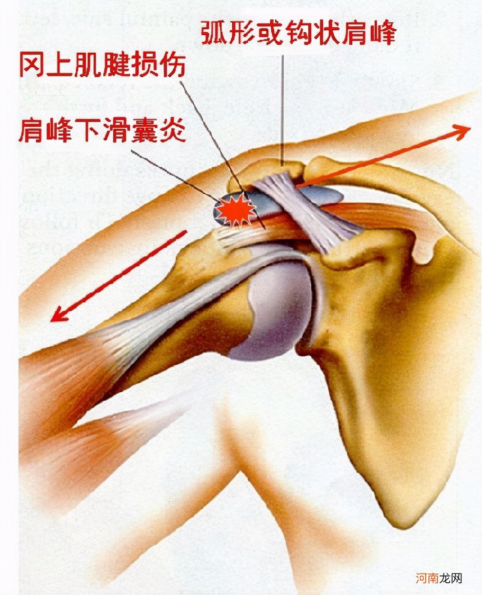 天生蝴蝶骨的几率 蝴蝶骨和驼背的区别图