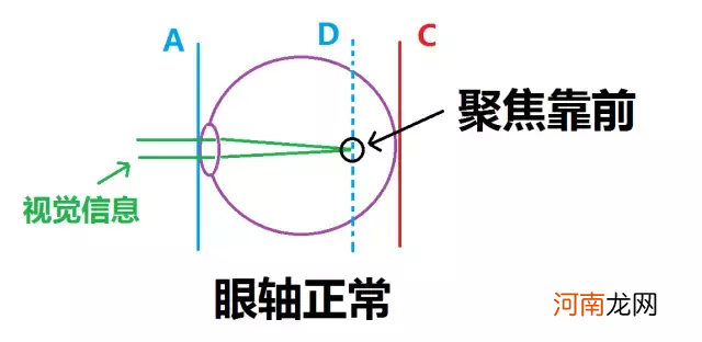 眼睛近视对生活的影响 近视眼的危害