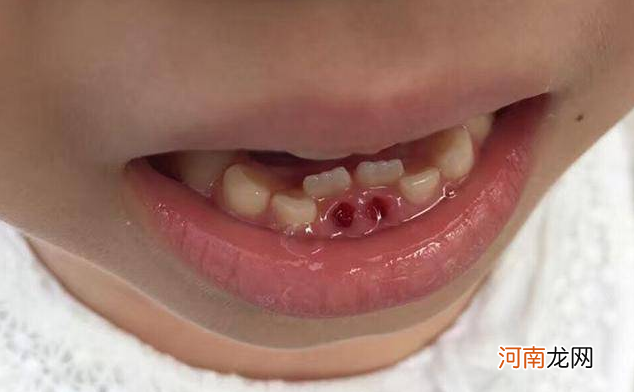 为什么长“双排牙”的孩子越来越多？原因都在家长身上，别不知道