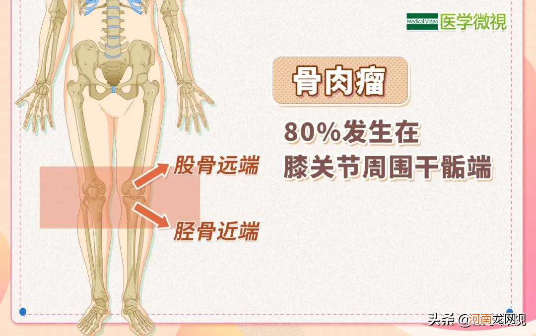 膝关节疼痛的十大原因 什么癌症早期会膝盖疼