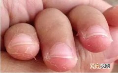 指头脱皮是怎么回事 手指肚一层层脱皮什么原因