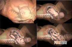 顺产图片全部过程 顺产用吸胎器对胎儿有影响吗