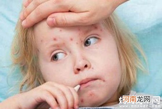 小孩出麻疹怎么办 出麻疹要注意什么