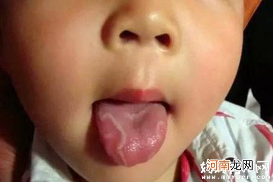 小舌头隐藏着大秘密 宝宝舌苔厚黄究竟是怎么回事