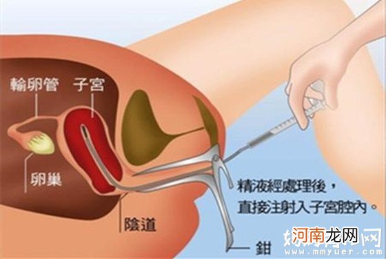 输卵管造影后多久可以要孩子 取决于造影方法及造影剂量