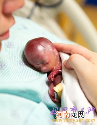 图片 美国妈妈产下19周早产儿 看着就揪心