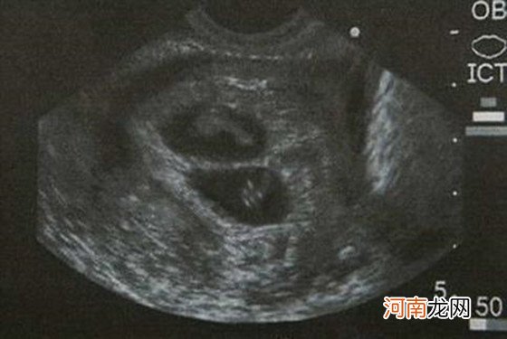 胎儿图片 一胎怀俩 怀孕双胞胎三个月肚子有多大