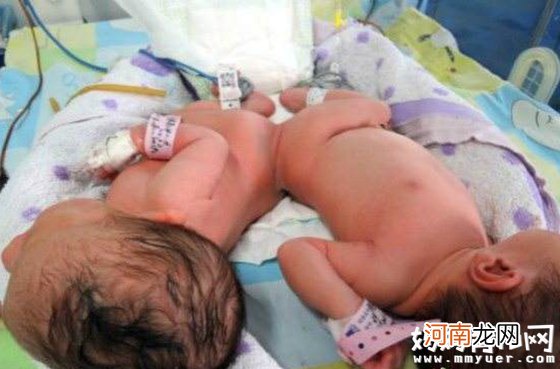 连体婴儿手术一桩接一桩 究竟同卵双胞胎多久才分开