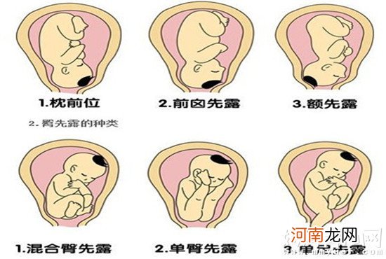 胎儿臀位怎么纠正有方法 不妨学学这三种姿势！