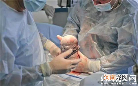 场面温馨又血腥 孕妈剖腹产生宝宝的全过程曝光