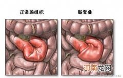 什么是肠套叠