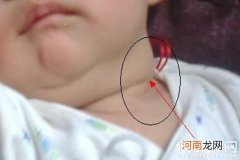宝宝斜颈是生病了吗？四个月的宝宝斜颈怎么回事！