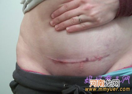 剖腹产疤痕让妈妈的肚皮变成这样吗？