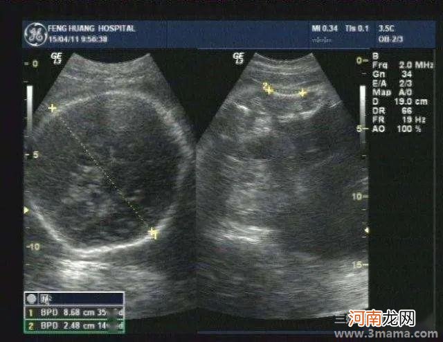 胎儿3D模型技术问世 或将取代传统超声照片