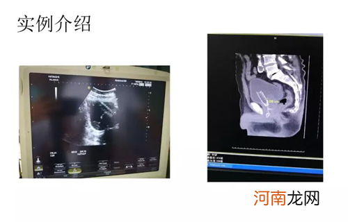 国内最新输尿管覆膜支架手术，解除小便难的困扰