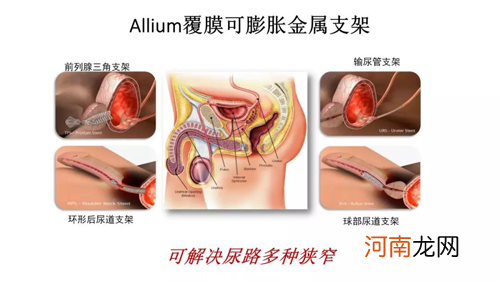 国内最新输尿管覆膜支架手术，解除小便难的困扰