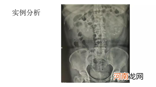 国内最新输尿管覆膜支架手术，解除小便难的困扰