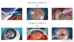 白内障手术治疗的三大认知误区