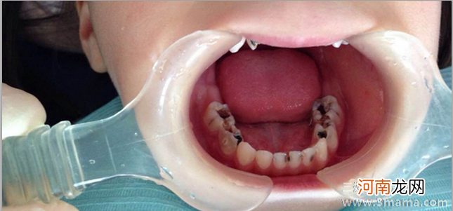 牙齿的维护，从婴儿开始