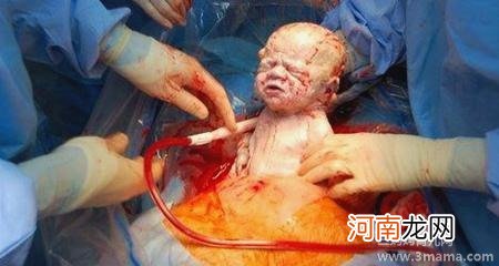 剖腹产几天不大便真苦恼！到底剖腹产多久拉大便正常？