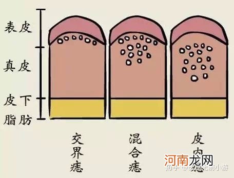 什么样的痣会发生癌变？