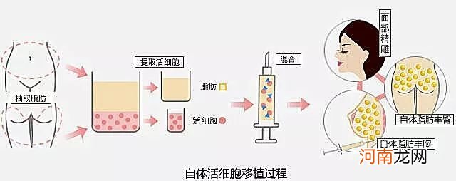 自体脂肪填充 如何最大程度避免多次填充？