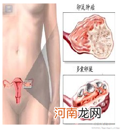 多囊卵巢怀孕几率多大，看看多囊多了啥？