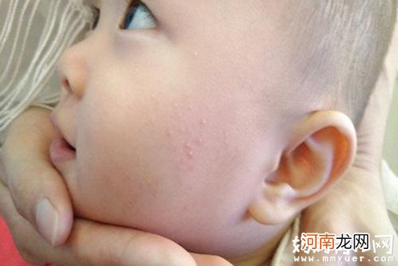 宝宝湿疹原因分析 是治疗婴儿湿疹的第一步骤