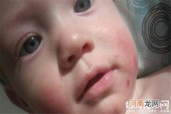 宝宝湿疹原因分析 是治疗婴儿湿疹的第一步骤