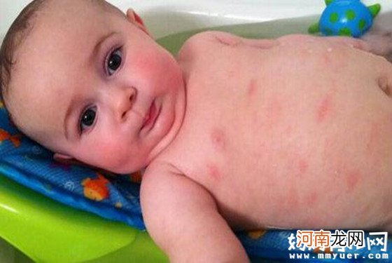 【婴儿湿疹】婴儿湿疹症状图片 婴儿湿疹怎么办？