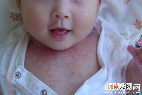 【婴儿湿疹】婴儿湿疹症状图片 婴儿湿疹怎么办？