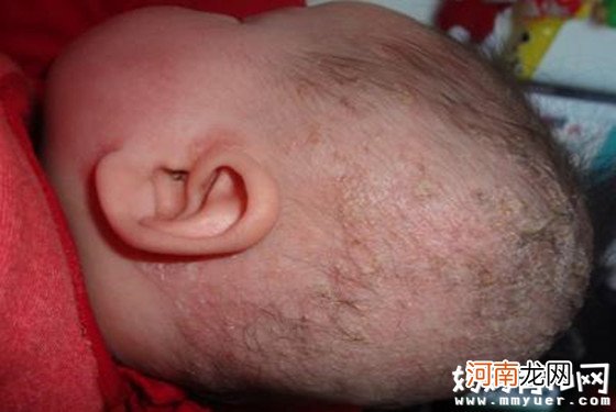 婴儿湿疹初期症状图片 别再和痱子傻傻分不清了