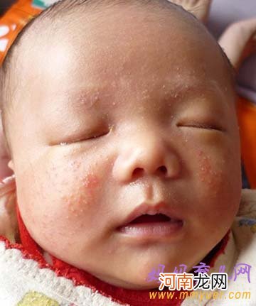 什么是婴儿湿疹 婴儿湿疹症状图片