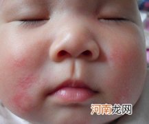宝宝湿疹严重，反复发作的根治方法