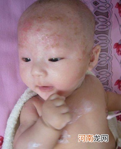 宝宝患湿疹 原来都是抗生素惹的祸