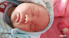 婴儿宝宝湿疹反复发作怎么办？