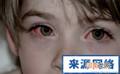 红眼病的治疗方法 儿童红眼病的治疗方法