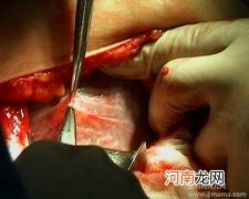 剖腹产横切二胎怎么切