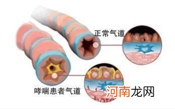 什么是支气管哮喘