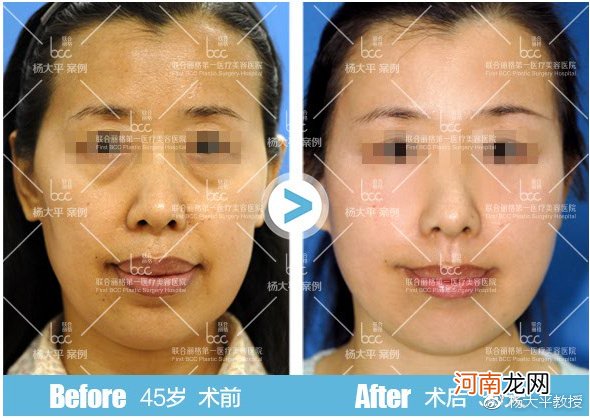 为什么面部提升手术要与眼部整形一起做效果更好？