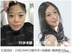 为什么面部提升手术要与眼部整形一起做效果更好？