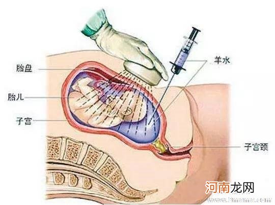 羊水穿刺的风险什么时候需要羊水穿刺