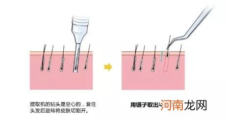 你还在为脱发烦恼吗？