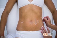 腹部吸脂会影响生育吗？快看腹部吸脂的5个误区