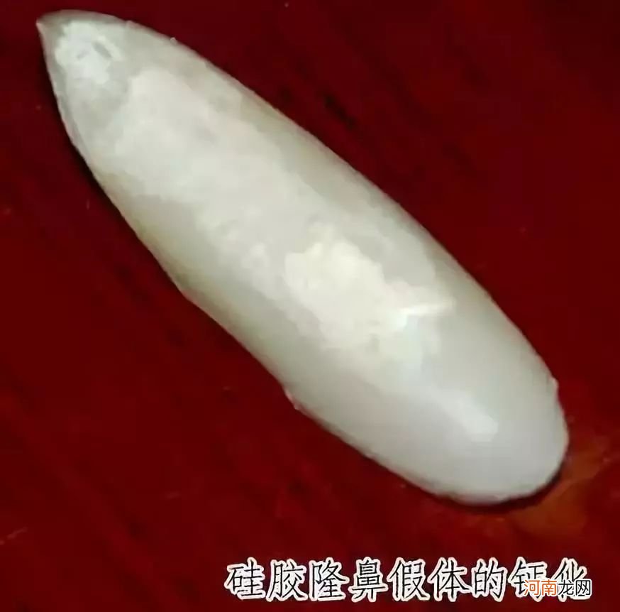 鼻整形术后几年乃至几十年后需要更换假体吗？