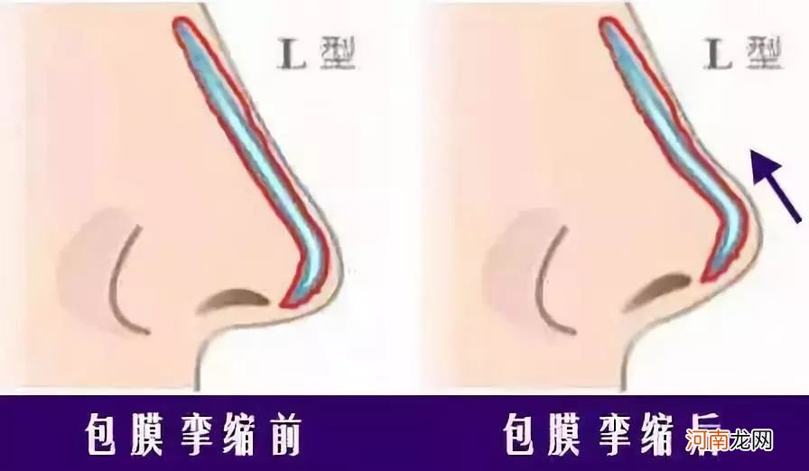 鼻整形术后几年乃至几十年后需要更换假体吗？