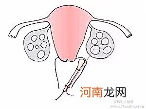 试管婴儿移植后腹痛的三大原因，别怕！应对处理就好