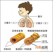 儿童哮喘病发病时的饮食
