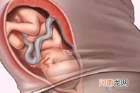 胎儿脐带绕颈的原因和注意事项 脐带绕颈可以顺产吗